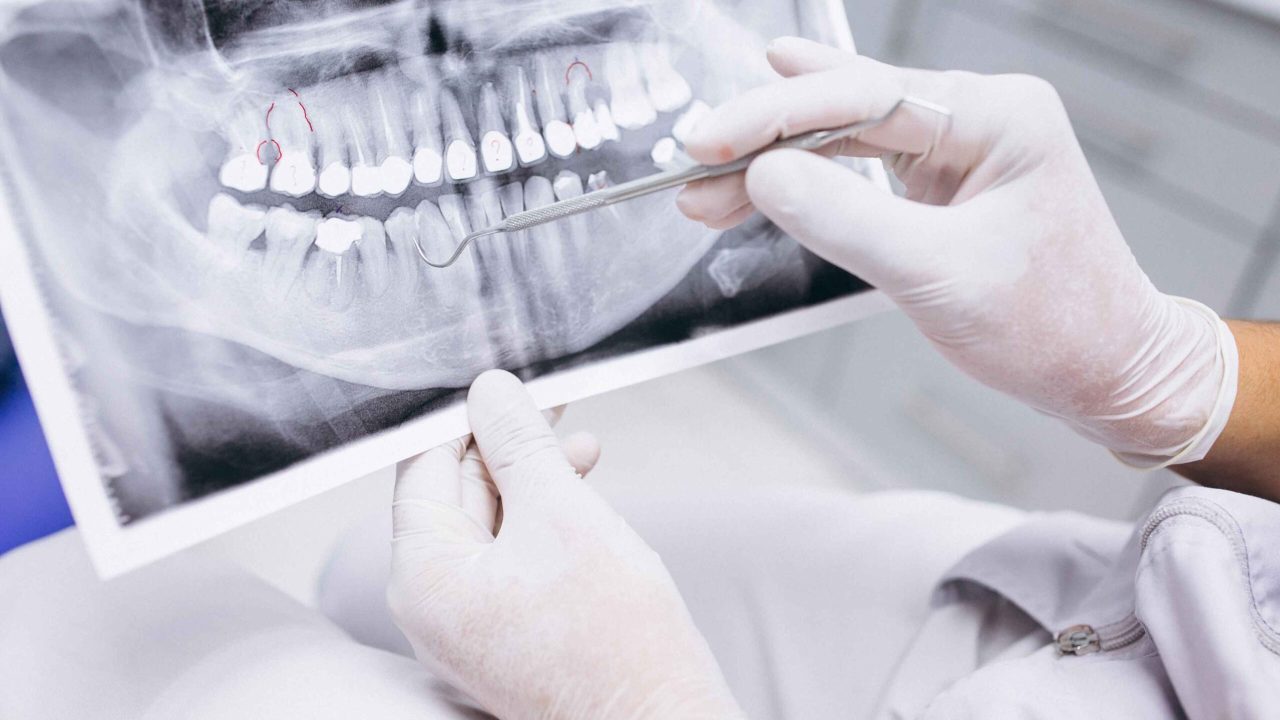 x-ray-teeth_2_11zon